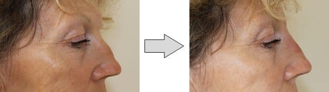 avant-apres-rhinoplastie-medicale-nice Avant apres rhinoplastie medicale nice